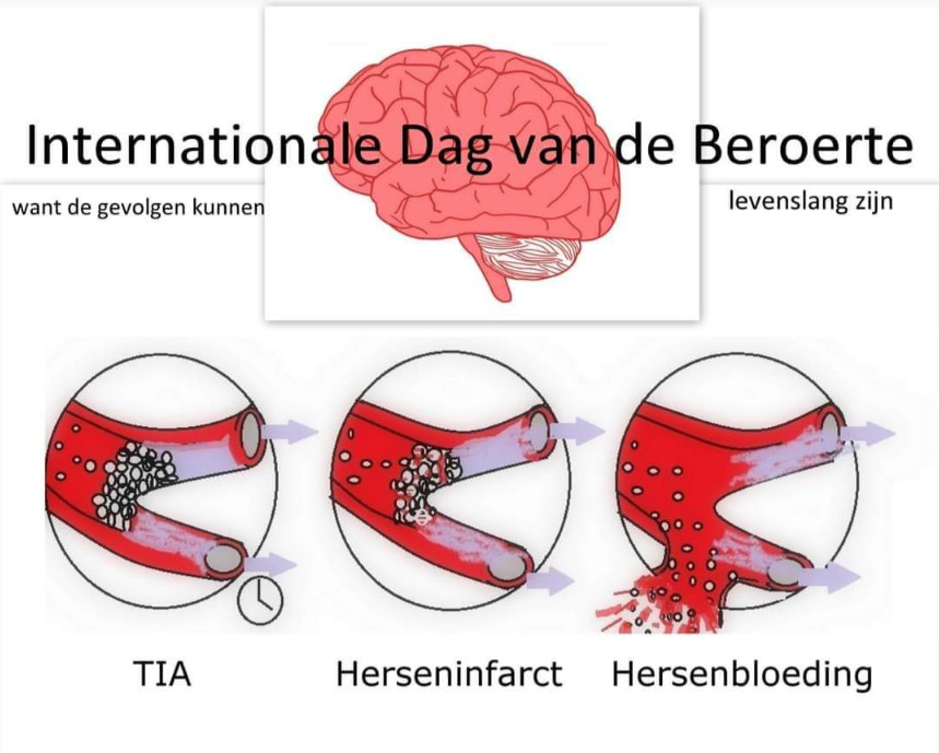 Europese Dag van de Beroerte 2026 : FAST test